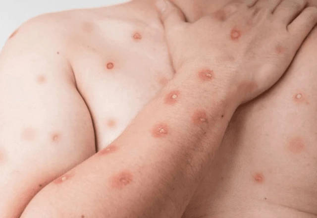 Mpox pode causar erupção dolorosa, linfonodos inchados, febre, dor de cabeça, dor muscular, dor nas costas e baixa energia 