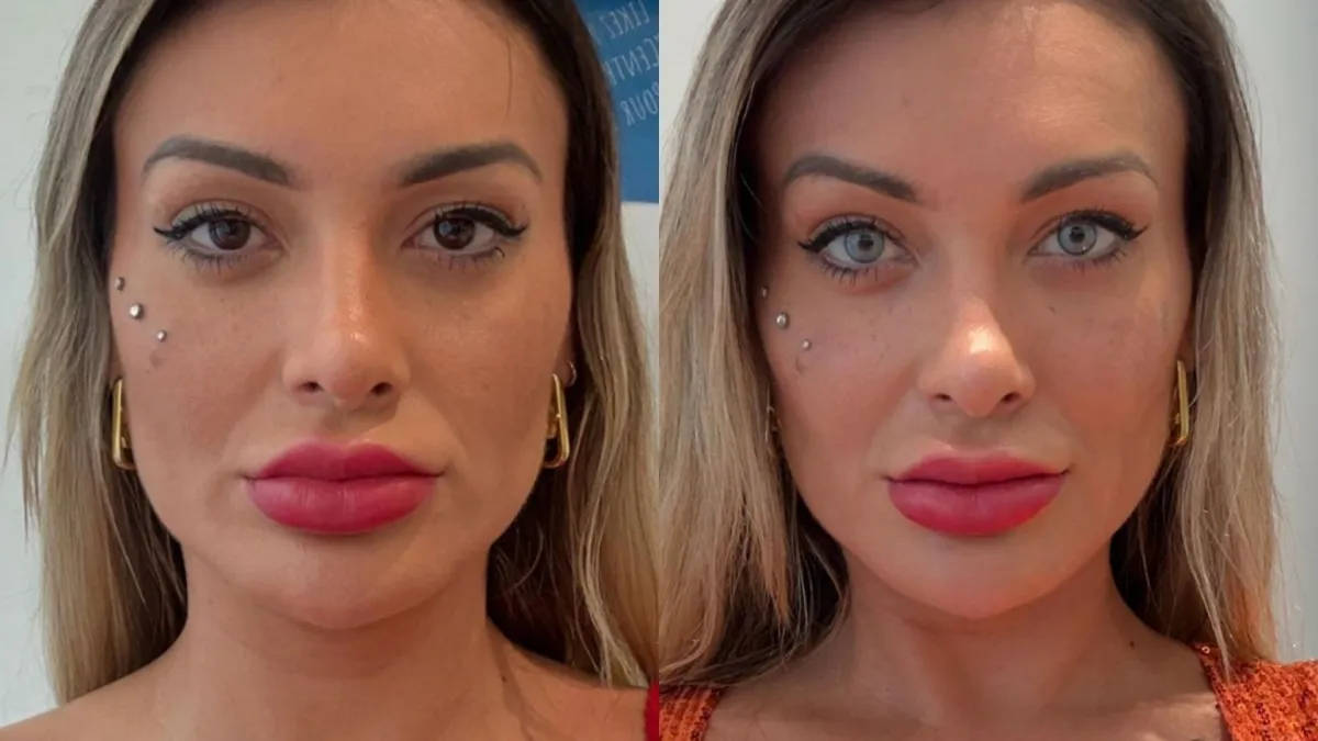 Método utilizado pela influenciadora Andressa Urach consiste na aplicação de pigmento na camada intermediária da córnea, alterando sua cor de forma permanente