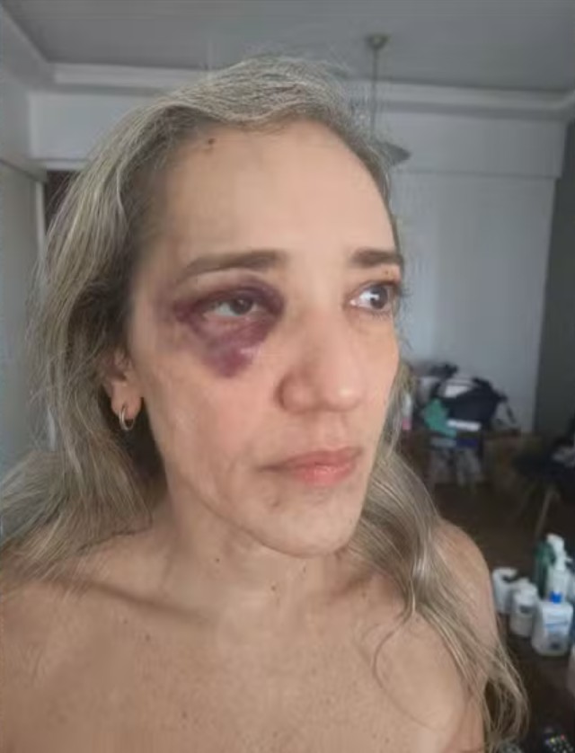 Ana Cristina Durão Nunes foi agredida com o capacete do motociclista 